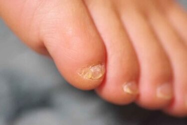 I don’t have a toenail on my little toe! Can I nail it? How can I take care of it?